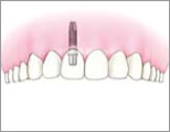 歯を1本失った場合：インプラント治療