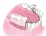 複数の歯を失った場合：他の歯にバネをかけて入れ歯を固定