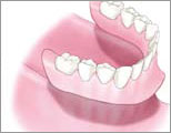 すべての歯を失った場合：歯ぐきとの吸着力で入れ歯を固定