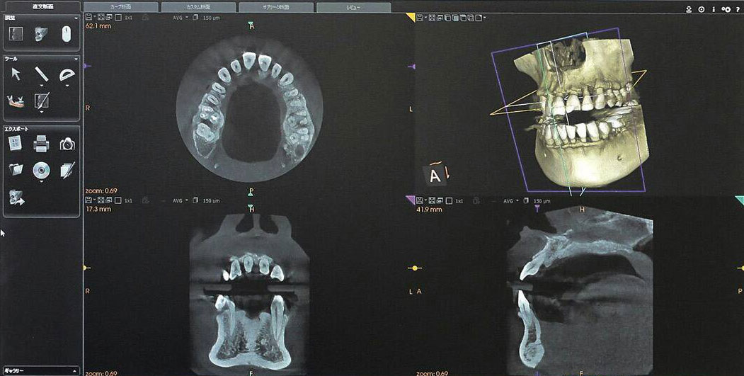 歯科用CT CT画像
